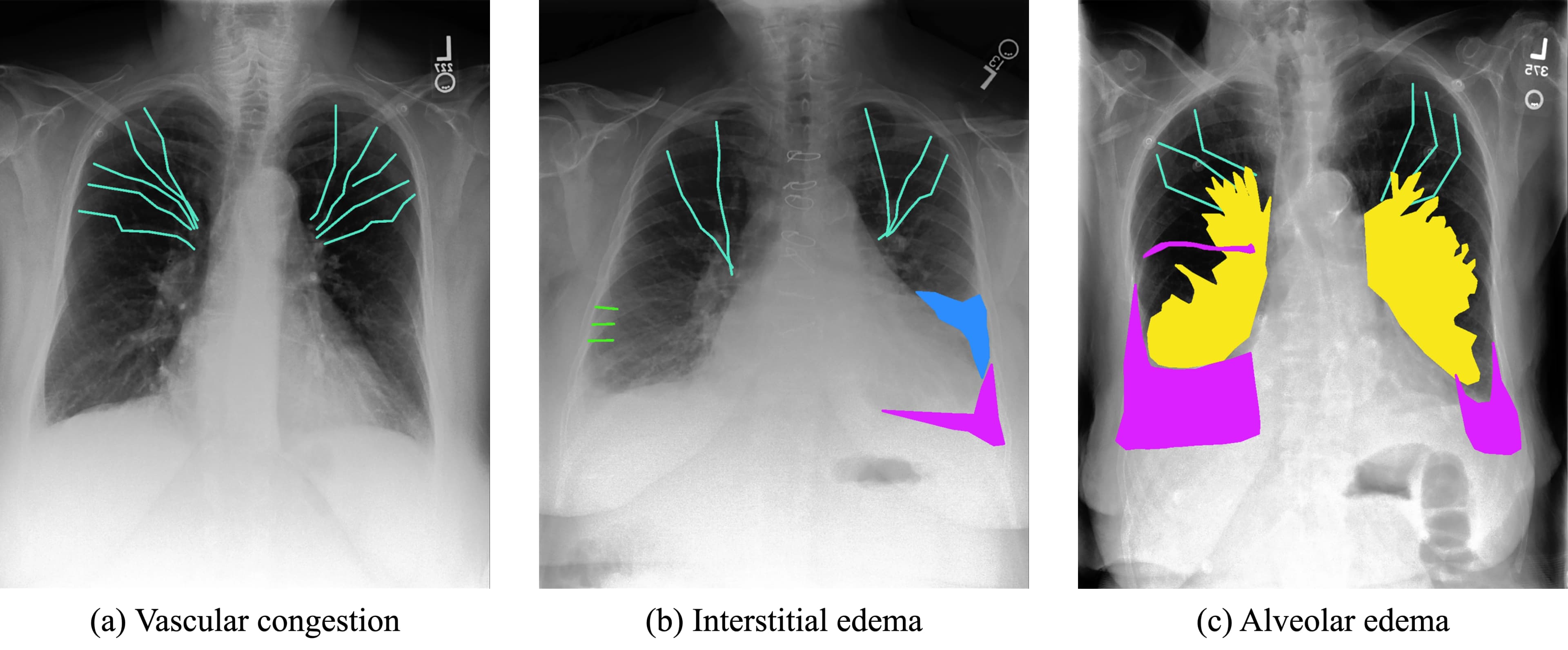 Chest X-ray Annotation Methodology