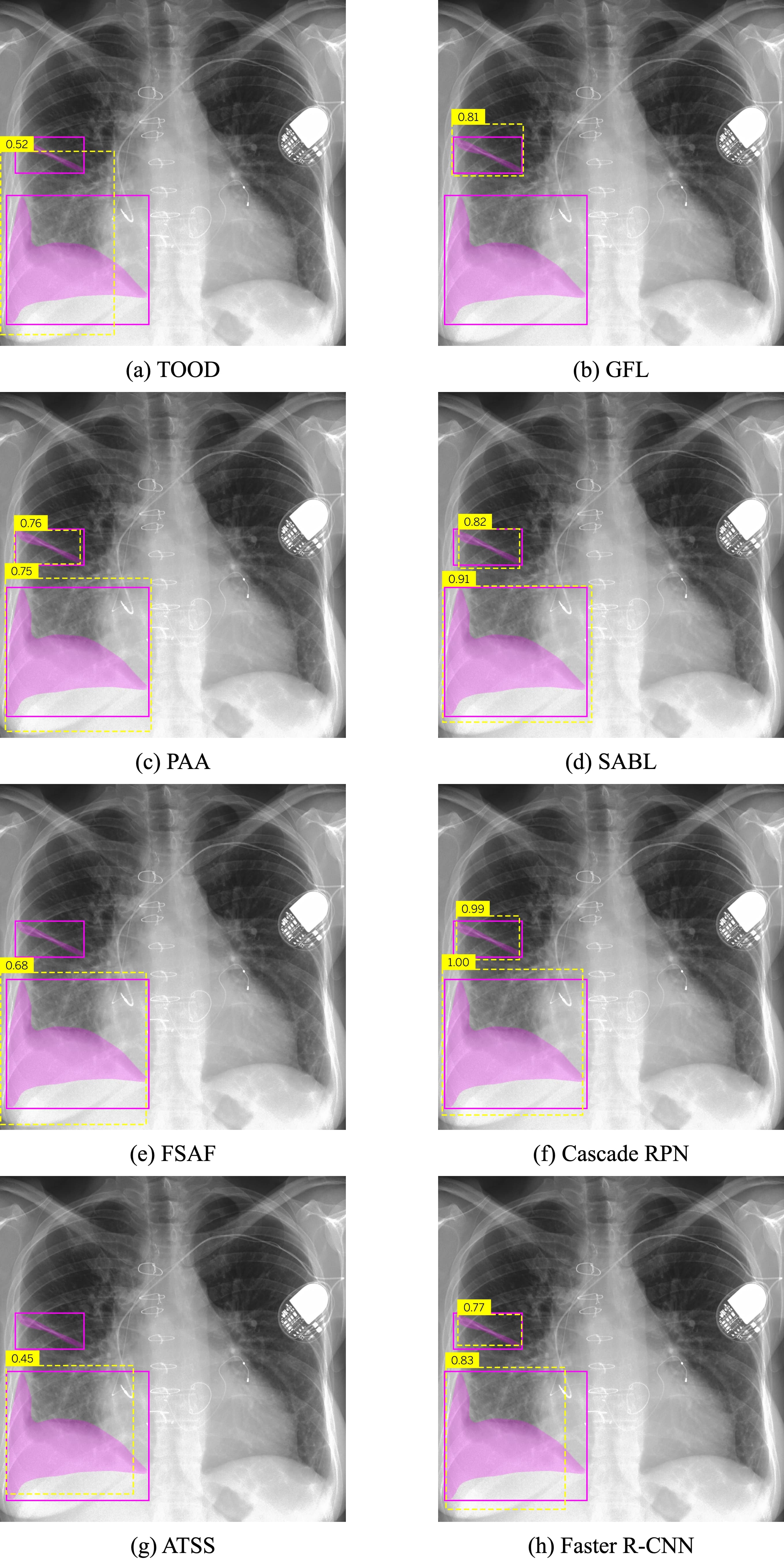Comparison of Pleural Effusion Predictions