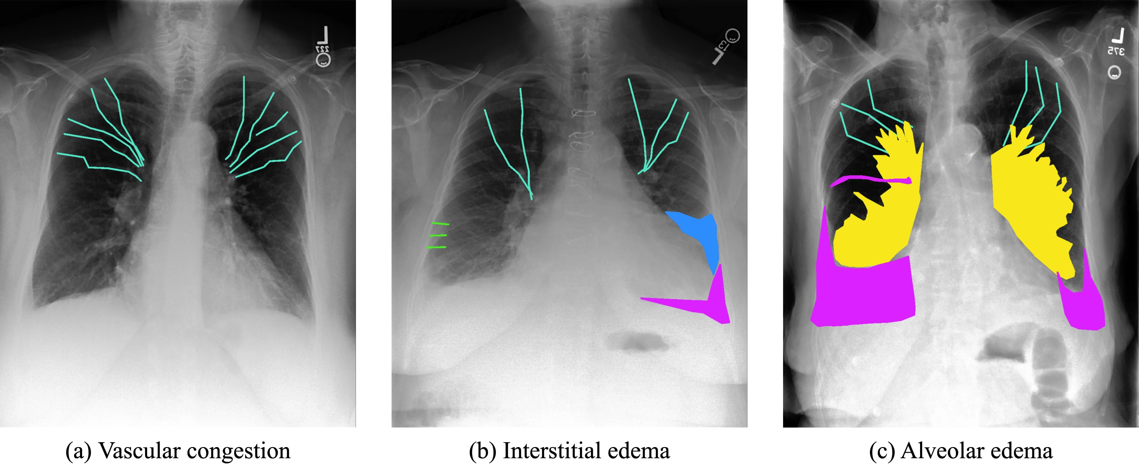 Chest X-ray Annotation Methodology