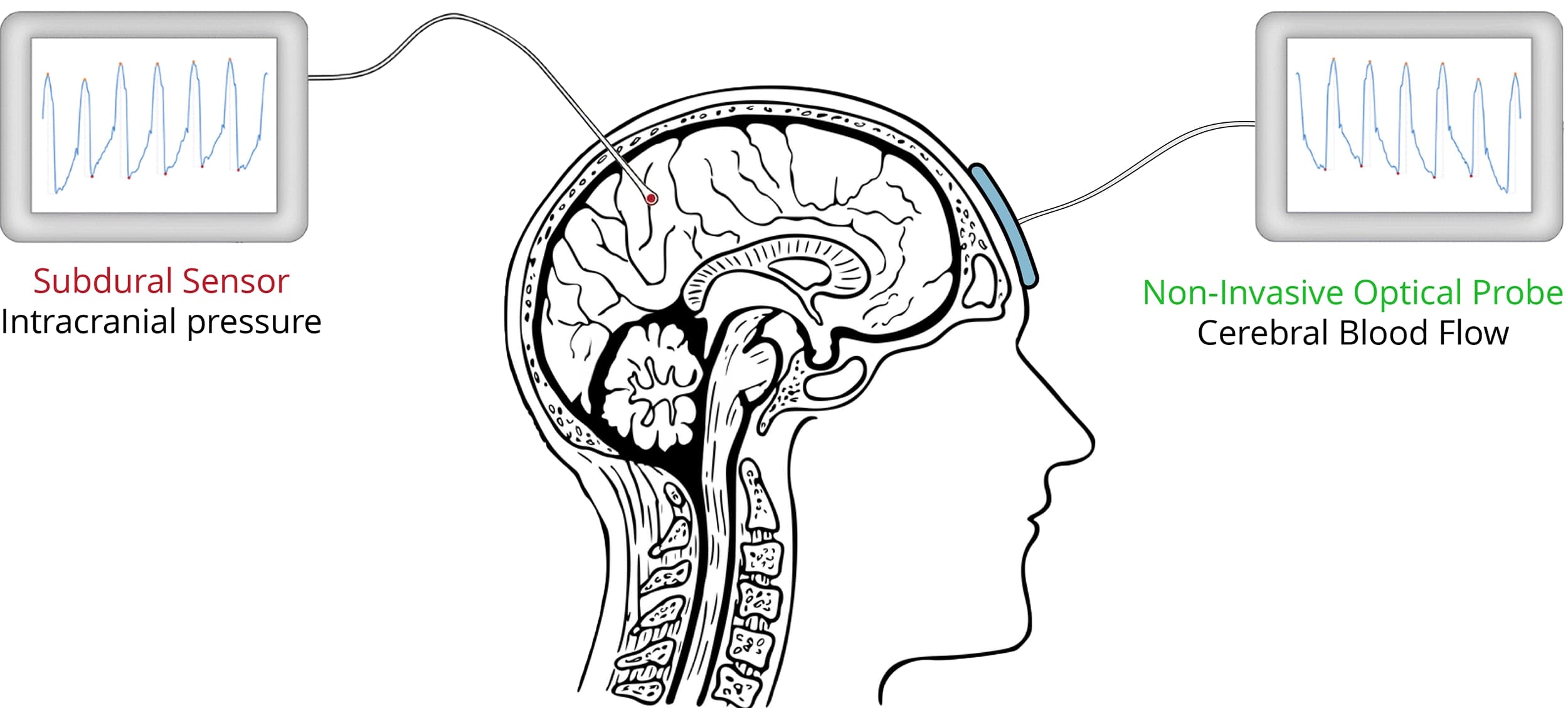 CBF and ICP Acquisition Setup